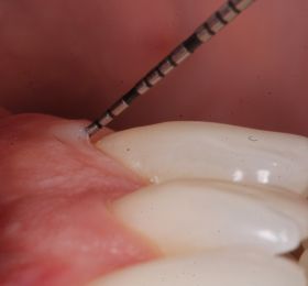 Manipulação de enxertos tecidual sobre dentes e Implantes