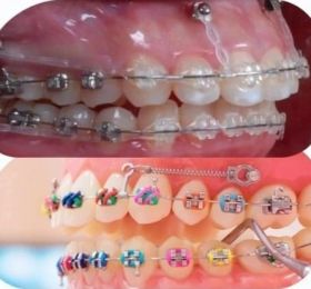 Mini Implantes - Intra e Extra Alveolares