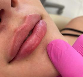 Toxina Botulínica e Preenchimento Facial com Prática Laboratorial e Clínica